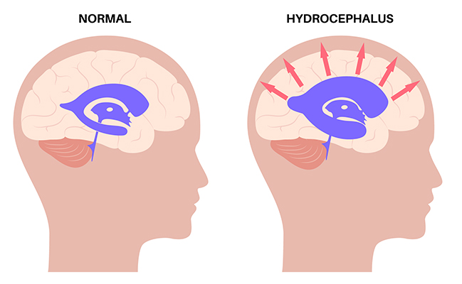 nph, Normal pressure hydrocephalus