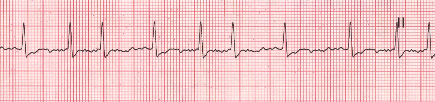 alcohol and afib