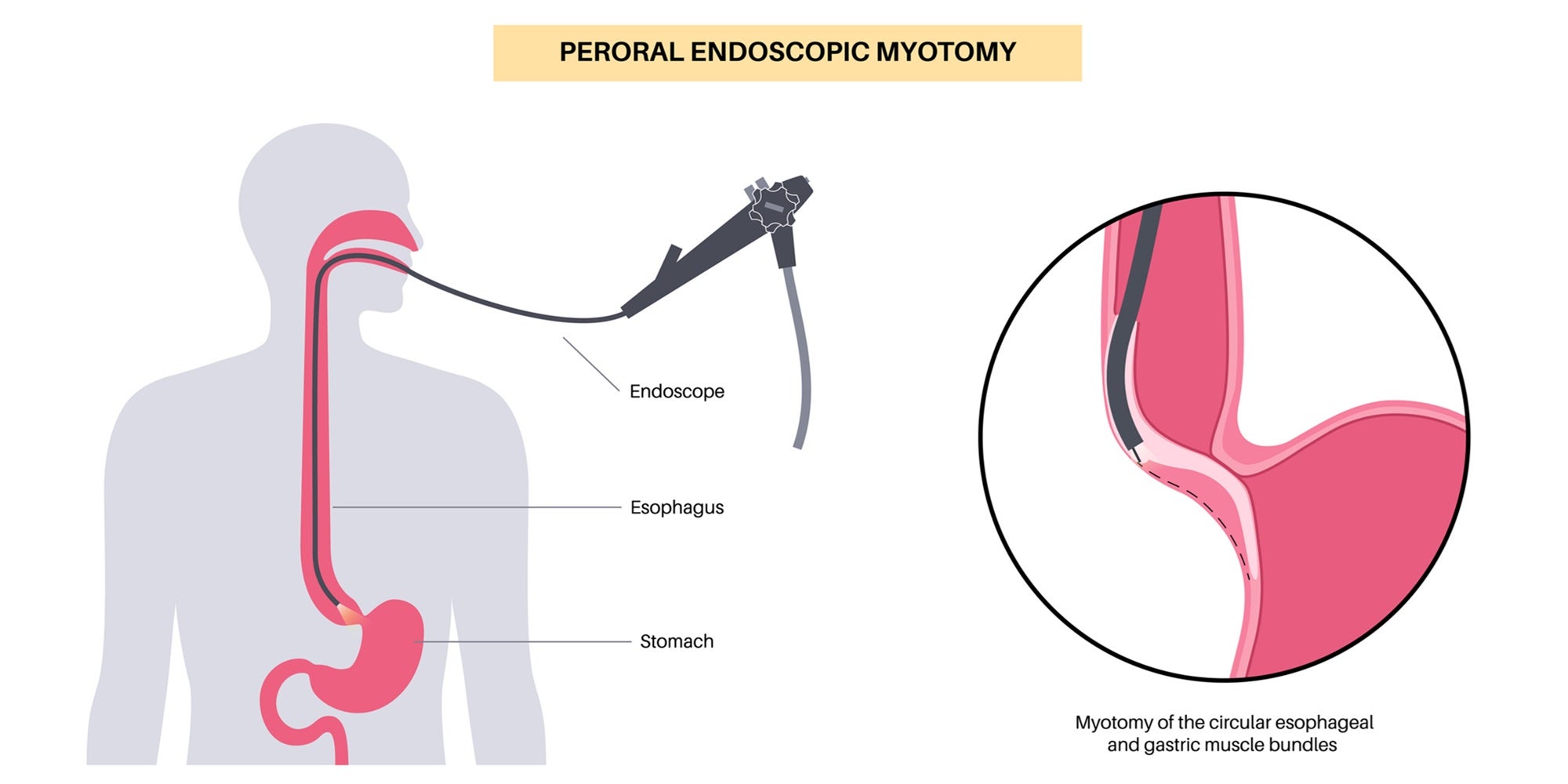 esophageal motility disorders, peroral endoscopic myotomy, poem procedure, achalasia esophagus