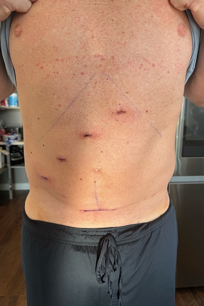 Taylor's incisions from Dr. Dattani’s robotic surgery.