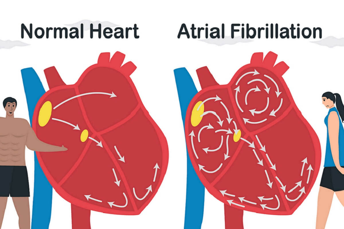 A Fib is the most common heart arrhythmia.