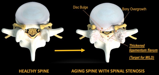 mild procedure for spinal stenosis, symptoms lumbar spinal stenosis, minimally invasive lumbar decompression