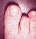 hammertoe, soft corn toe, lesser toe anatomy