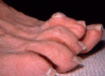 hammertoe, soft corn toe, lesser toe anatomy