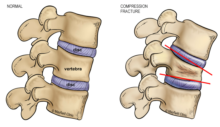 vertical compression fracture spine