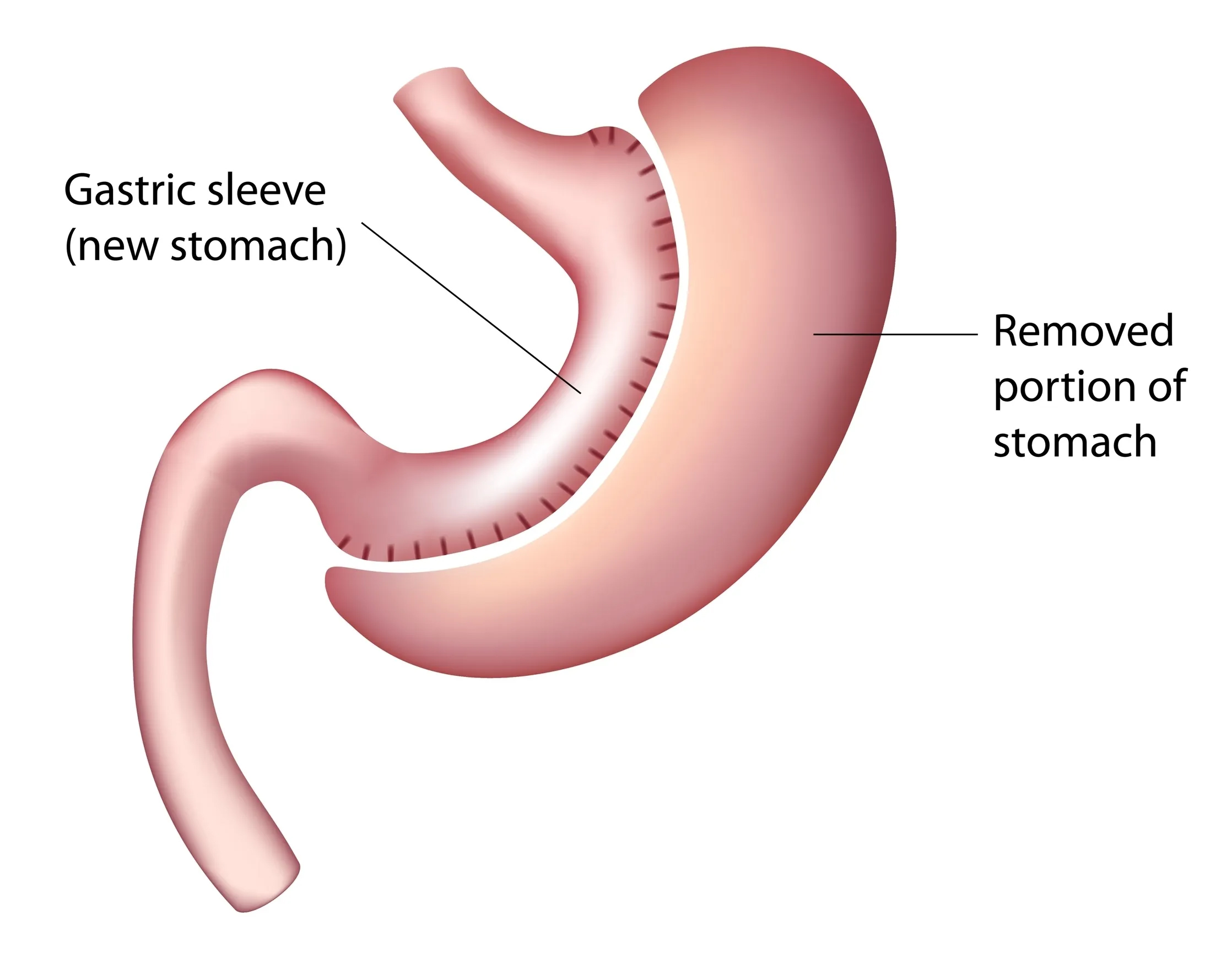 gastrectomy illustration