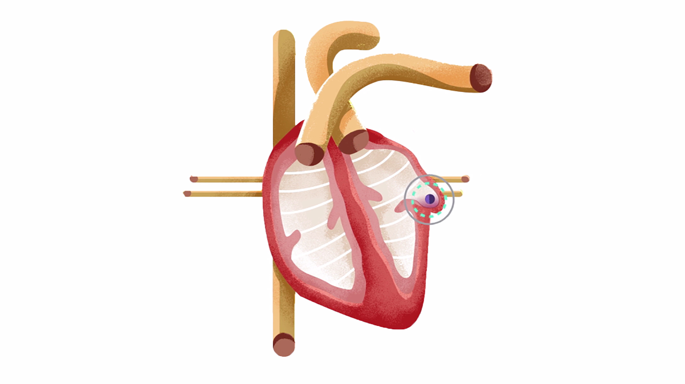 More than 90% of stroke-causing clots that come from the heart are formed in the LAA.