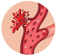 Hemorrhagic Stroke