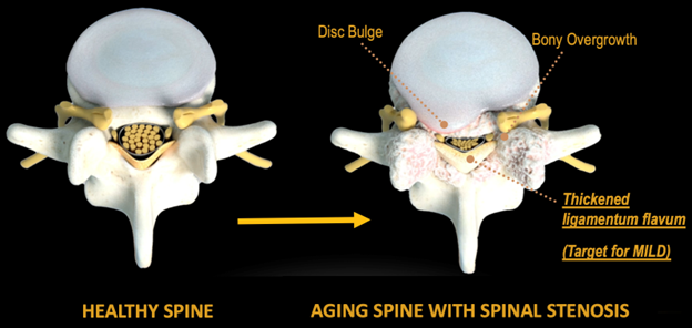 Spinal Stenosis