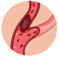 Ischemic Stroke