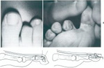 hammertoe, soft corn toe, lesser toe anatomy