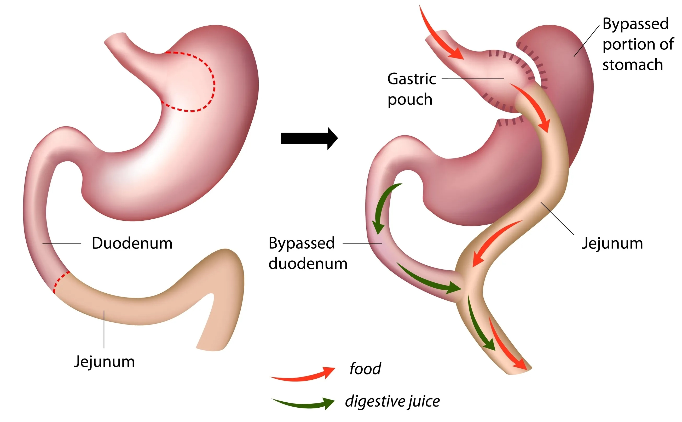 gastric bypass illustration