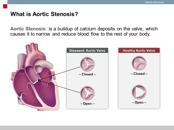 atrial septal defects, aortic stenosis, structural heart program