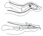 hammertoe, soft corn toe, lesser toe anatomy