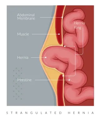 Types of hernias